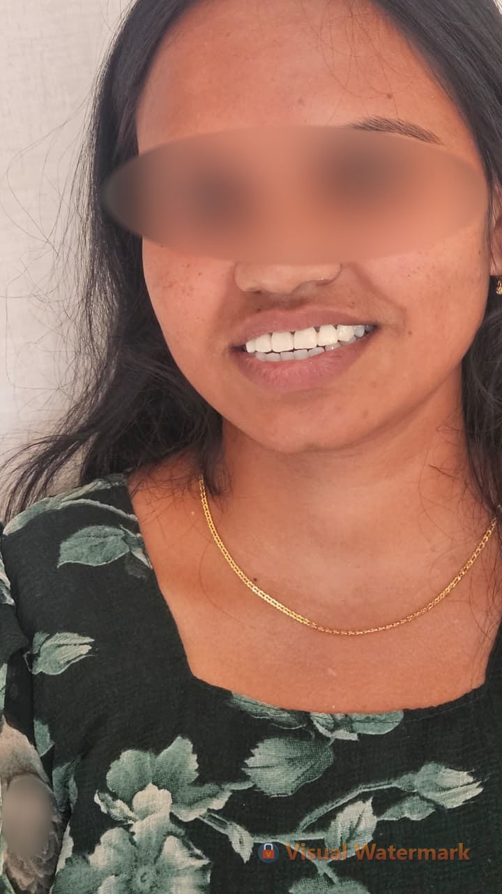 Dental treatment after — patient 11 smile transformation at Durge Dental Mancherial
