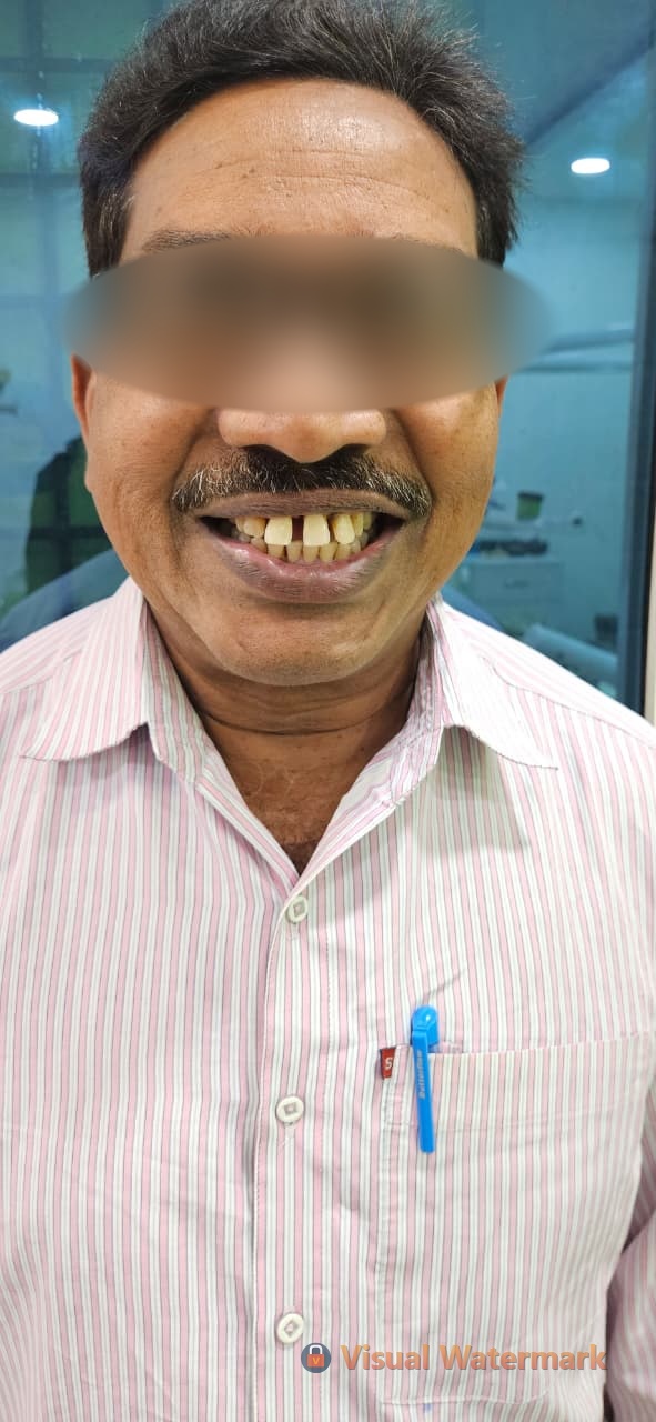 Dental treatment before — patient 7 at Durge Dental Clinic Mancherial