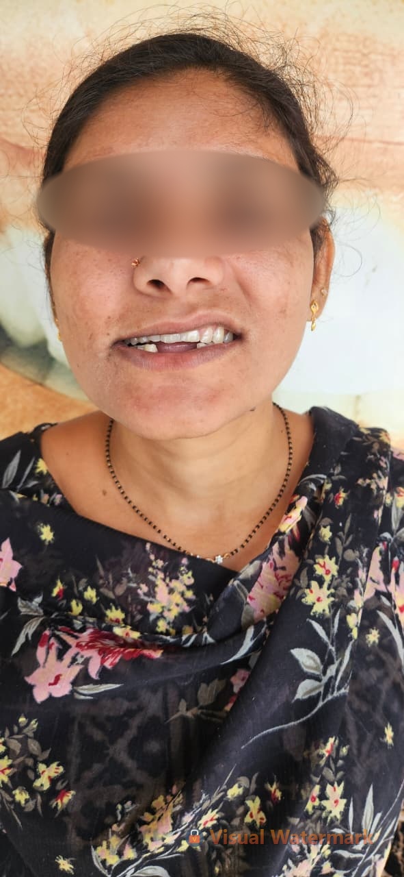 Dental treatment before — patient 16 at Durge Dental Clinic Mancherial