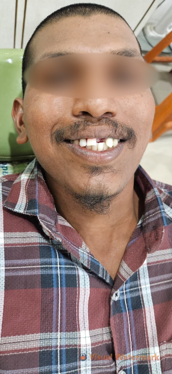 Dental treatment before — patient 9 at Durge Dental Clinic Mancherial