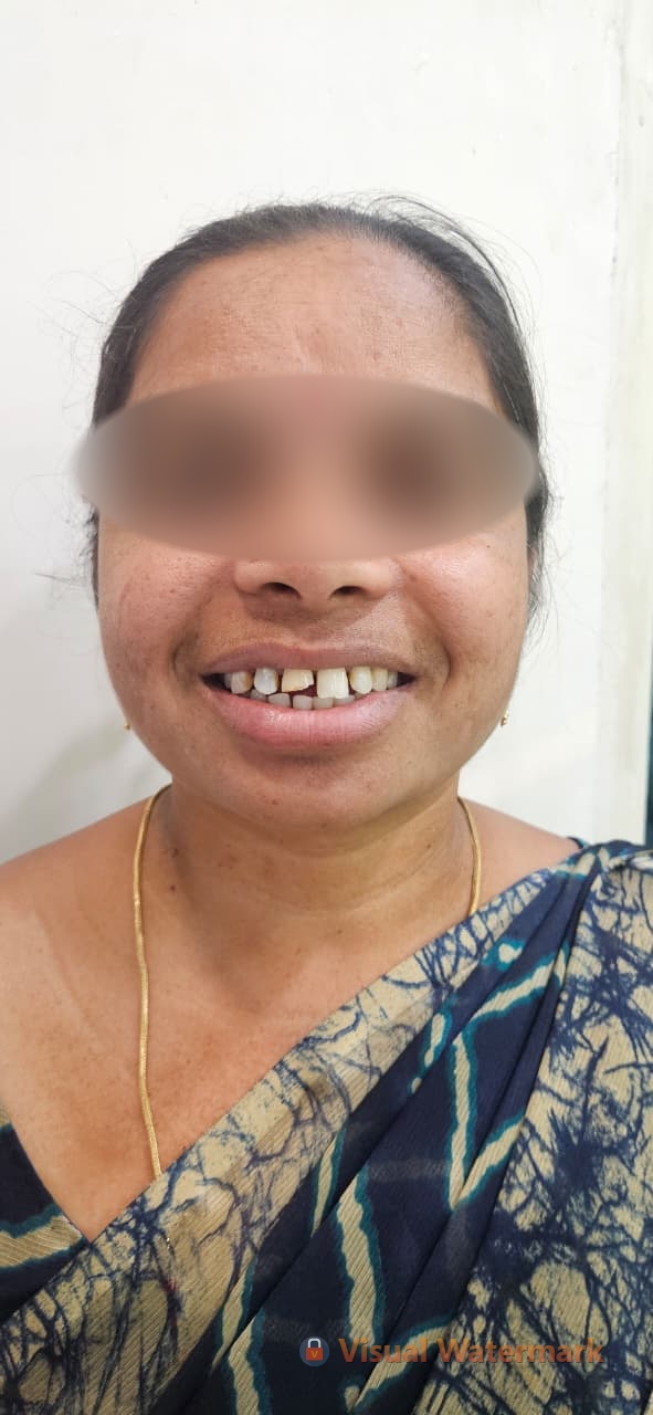 Dental treatment before — patient 10 at Durge Dental Clinic Mancherial