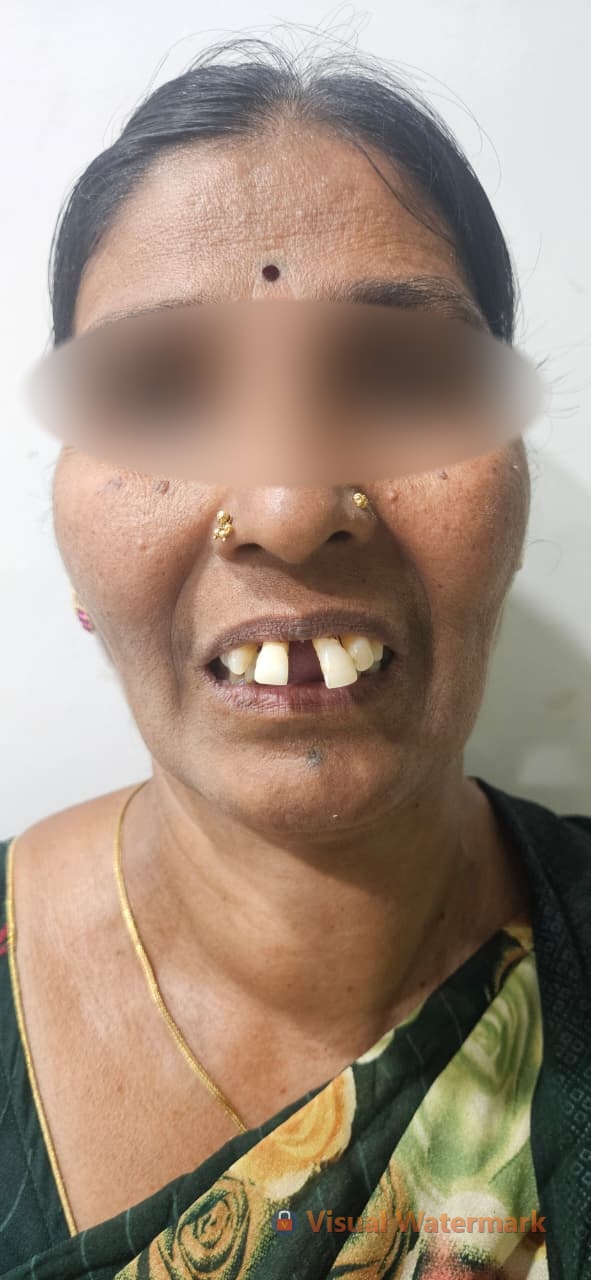 Dental treatment before — patient 13 at Durge Dental Clinic Mancherial