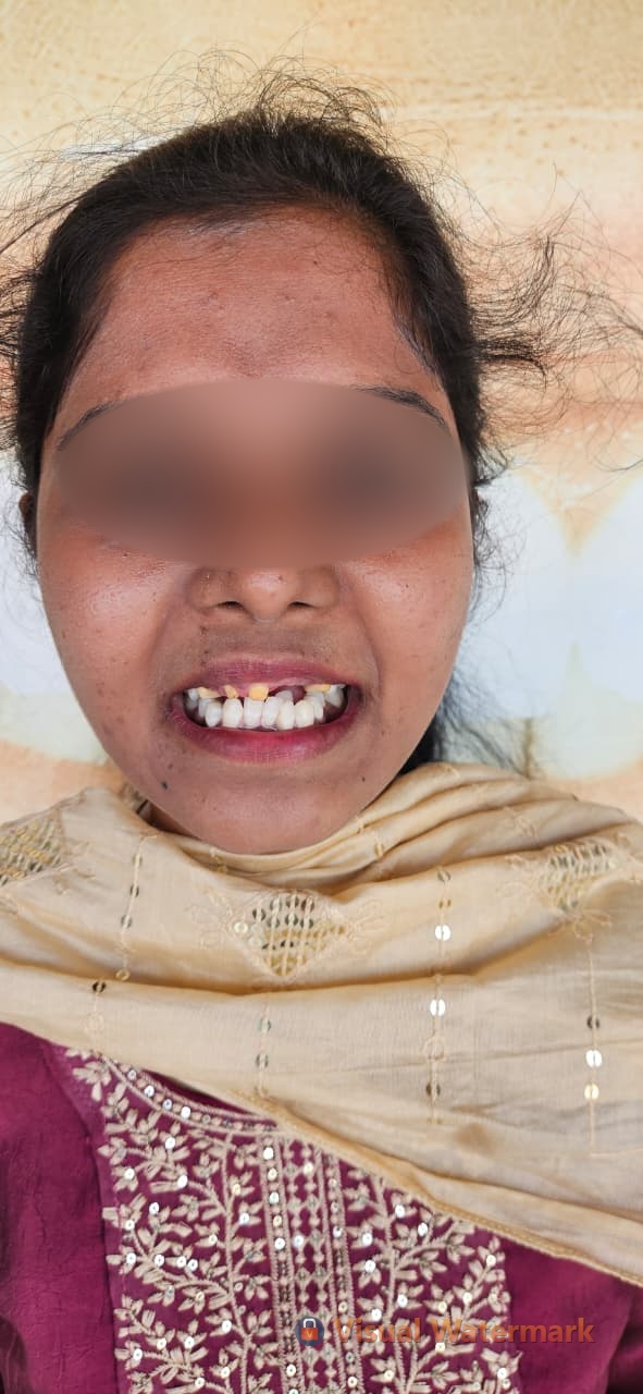 Dental treatment before — patient 14 at Durge Dental Clinic Mancherial