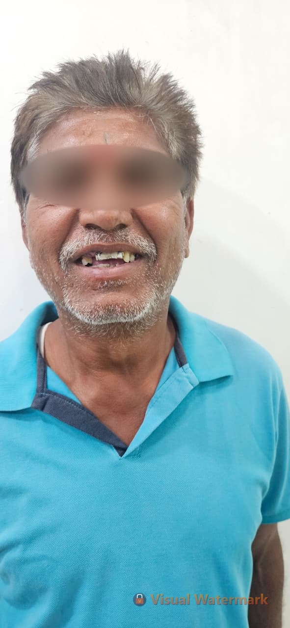 Dental treatment before — patient 15 at Durge Dental Clinic Mancherial